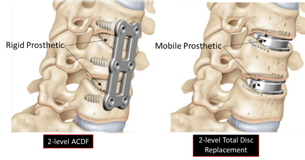 Newest-Treatment-Spinal-Stenosis